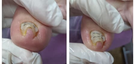 Service image for Встановлення корегуючої системи Титанова нитка