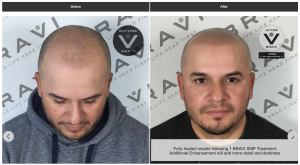 before-after photos showing how bravi scalp micropigmentation restores hairline and hair density