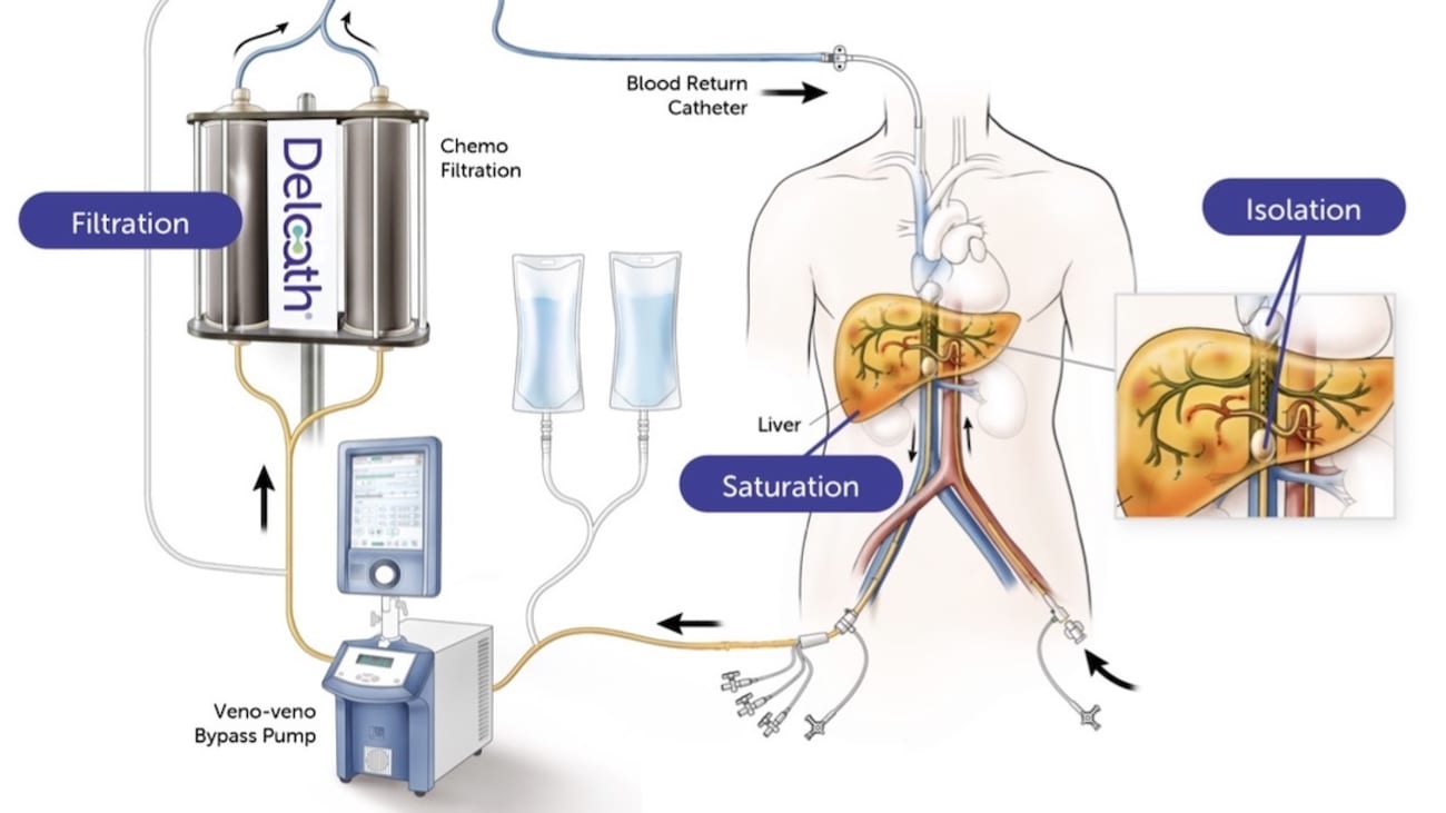 First patient in Texas receives new treatment for metastatic uveal melanoma  at UT Southwestern - UT Southwestern Medical Center