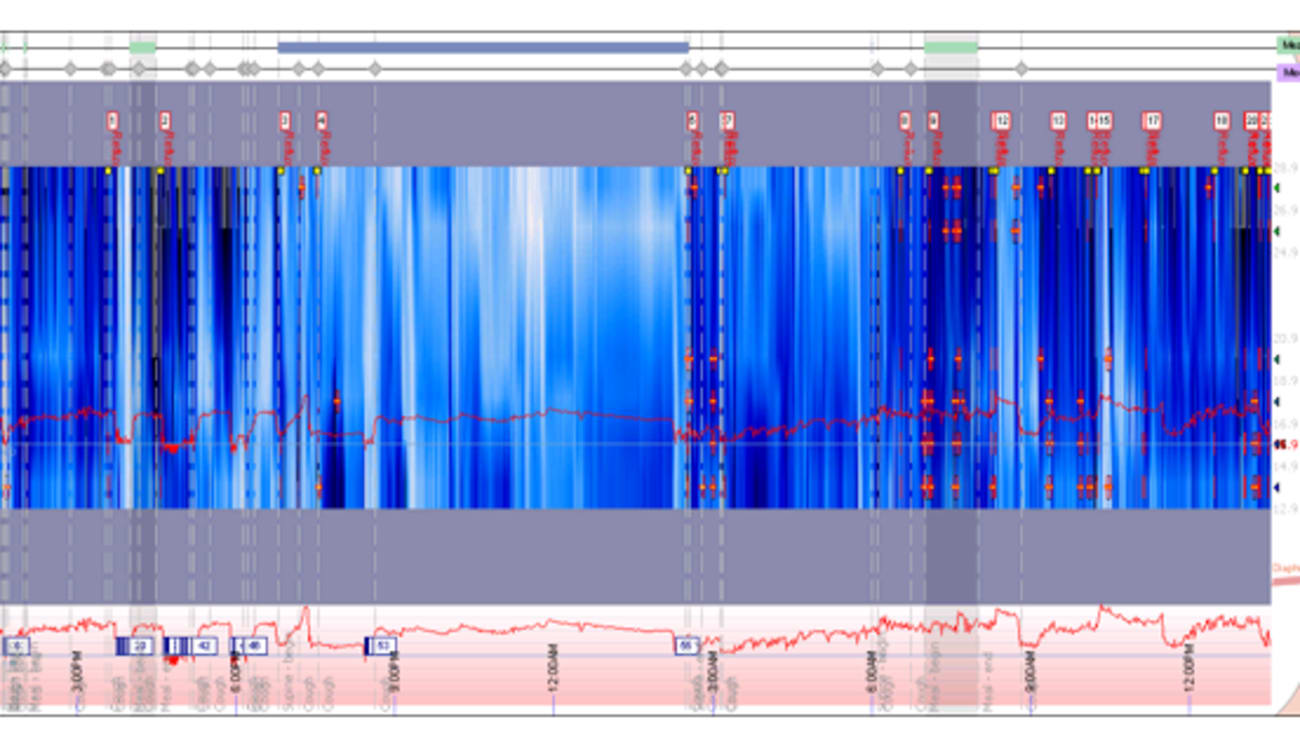 Patients with scleroderma often suffer from acid reflux. Among the tests Tsion Abdi and her colleagues perform to measure the condition’s severity is this pH impedance test. Reflux events are indicated at the top of the graph.