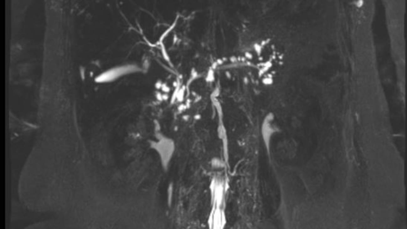 MRCP scan of a patient with innumerable pancreatic cysts