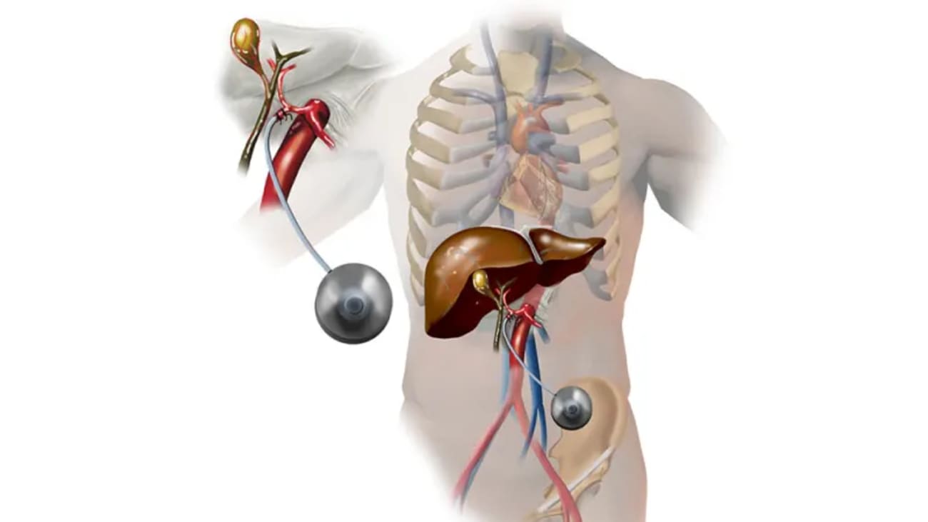 Figure 1: Hepatic artery infusion (HAI) involves the continuous infusion of floxuridine directly into the liver from a subcutaneous pump linked to a catheter surgically implanted in a branch of the hepatic artery.