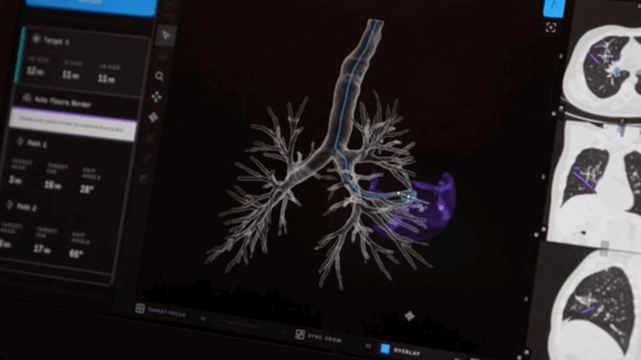 Robotic bronchoscopy, paired with 3D imaging, allows us to navigate an ultra-thin and very flexible tube with a camera on the end of it deep into the branches of the lungs to pinpoint suspicious lesions.