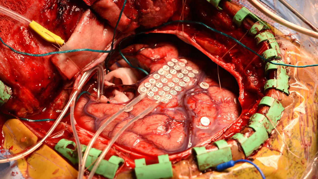 Intraoperative photo of ECoG recording during lesion resection to verify that epileptiform activity has stopped