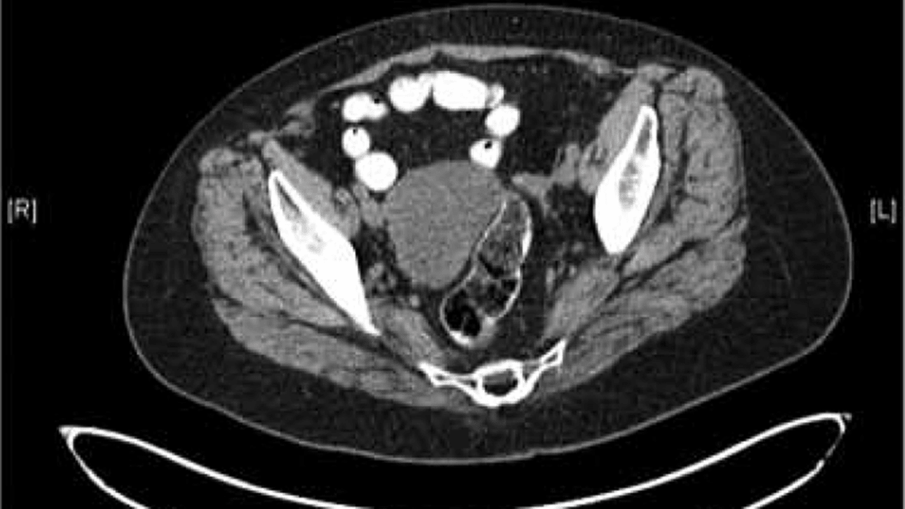 Figure 1: CT scan of the pelvis demonstrating right ovarian cystic mass in a patient with a history of mucinous colorectal carcinoma.