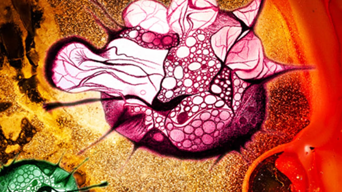 Endometrial cells migrate from the uterus to abdominal cavity and tissue to form endometriosis. Artist’s rendition by Ie-Ming Shih.