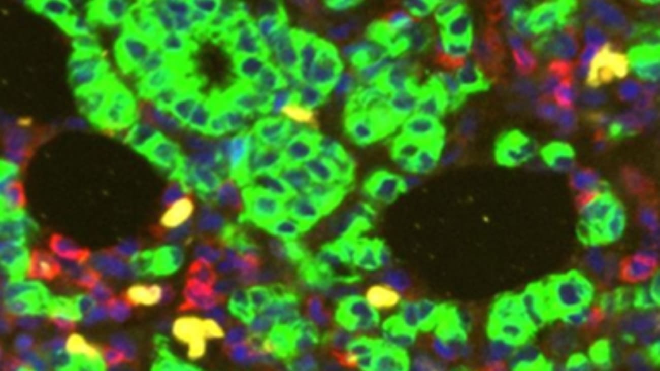 Breast cancers treated with estrogen-depriving therapy were examined using fluorescent markers to highlight cancer cells (green), immune cells (red), cells that are actively dividing (yellow), and DNA, which marks the nucleus of every cell (blue).