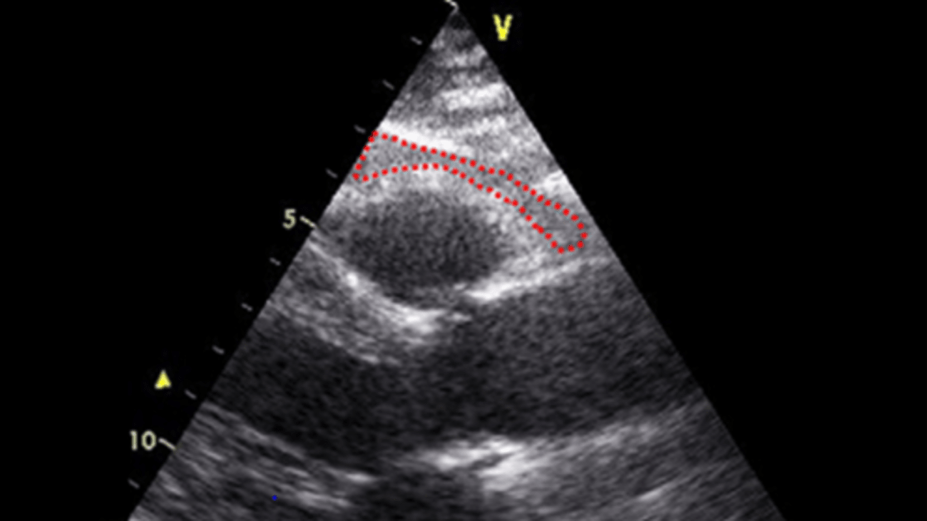 Pediatric Dyslipidemia
