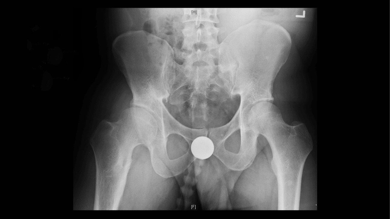 Figure 1: Pre-operative image of a 25-year-old male with retrotorsional femoral deformity and acetabular dysplasia and remodeling status post trauma as a child. He had combined instability and impingement of the hip, as well as an acetabular labral tear