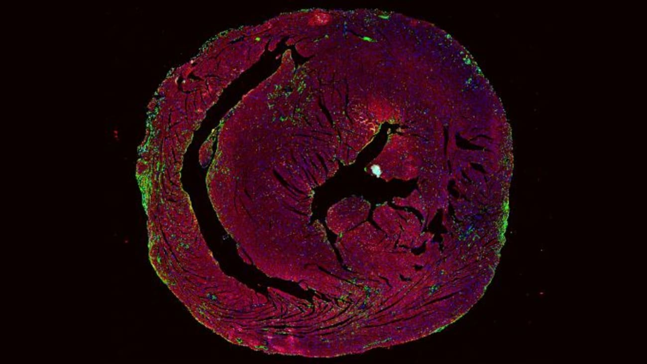 Figure of myocarditis with pink showing the heart tissue and green showing immune infiltration into the heart.