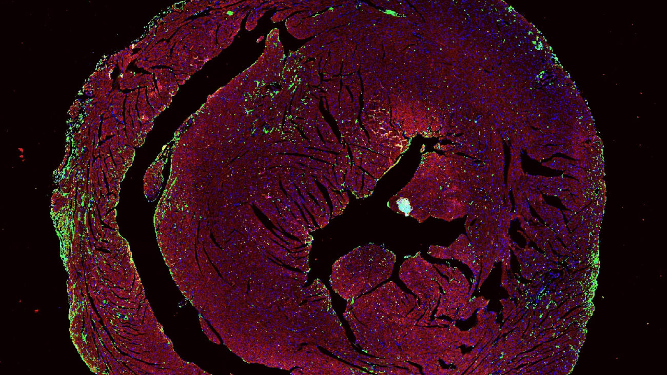 Study Suggests Mechanisms Behind Why Myocarditis Associated with Cancer Immunotherapies May Occur More Frequently in Female Patients