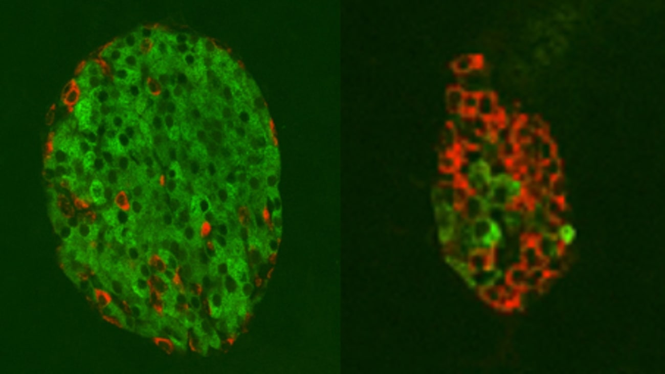 At left is a healthy islet with many insulin-producing cells (green) and few glucagon-producing cells (red). At right, this situation is altered in a diabetic islet with a heavy preponderance of glucagon-producing cells (red) and very few insulin-producing cells (green).