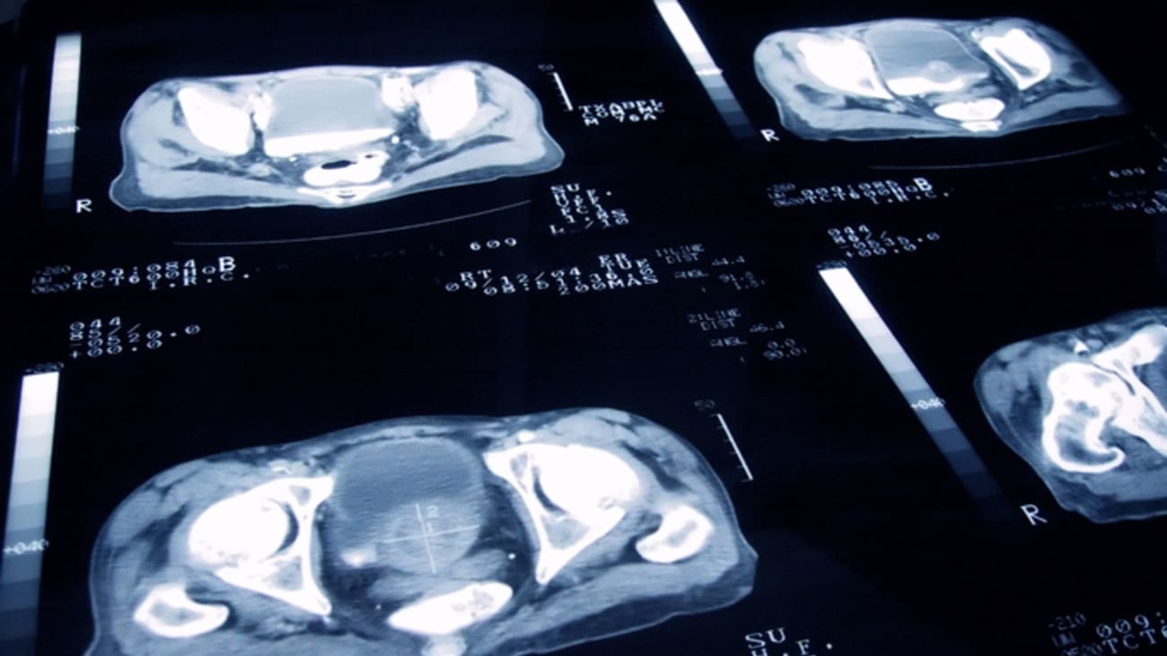 prostate cancer