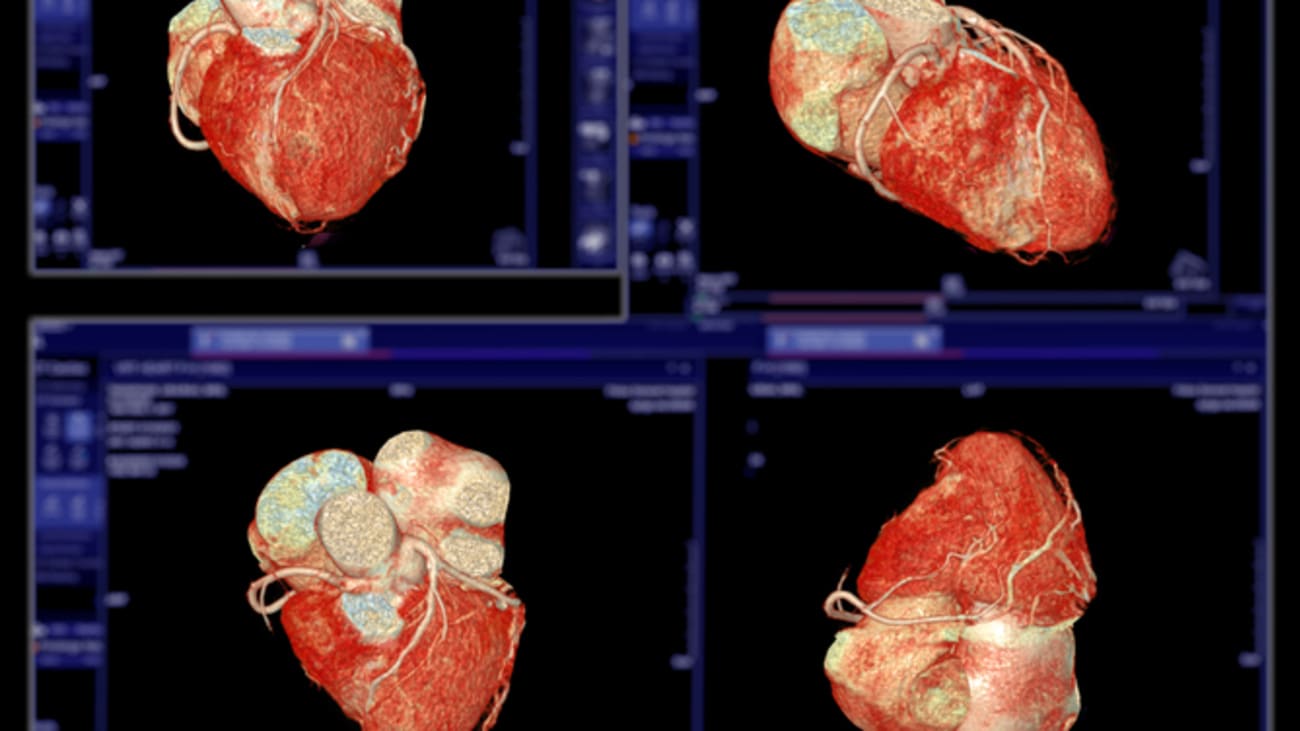 aortic disease