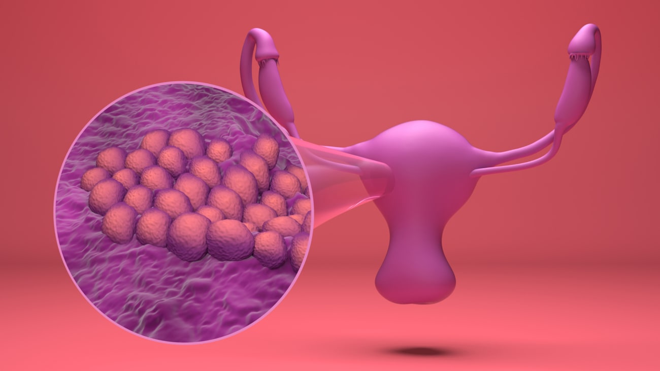 endometrial cancer