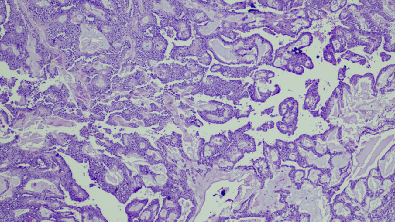 pancreatic cancer