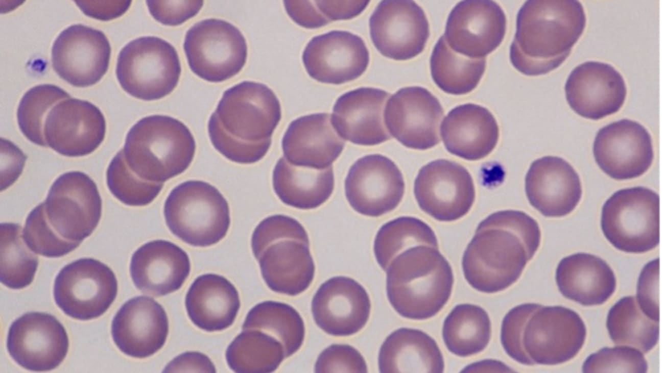 The latest research from Cedars-Sinai Guerin Children’s investigators has advanced our understanding of the role that blood platelets (shown here in dark purple) play in Kawasaki disease. Photo by Getty.