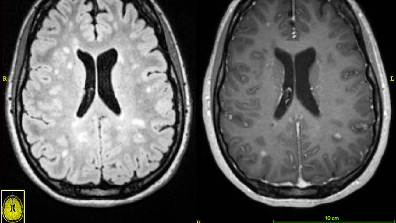 T2 hyperintensities and gadolinium-enhancing lesions in the supra- and infratentorial regions of the brain.