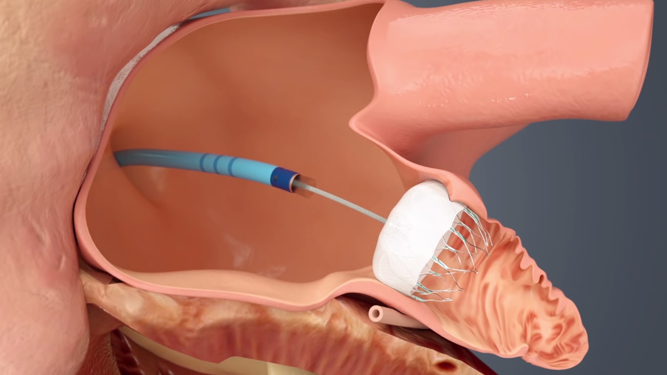 The Watchman device is already in use as an effective method of closing the left atrial appendage and preventing blood clots and stroke in patients with paroxysmal or persistent afib. A new clinical trial examines updates to the device, delivery system and surgical technique.