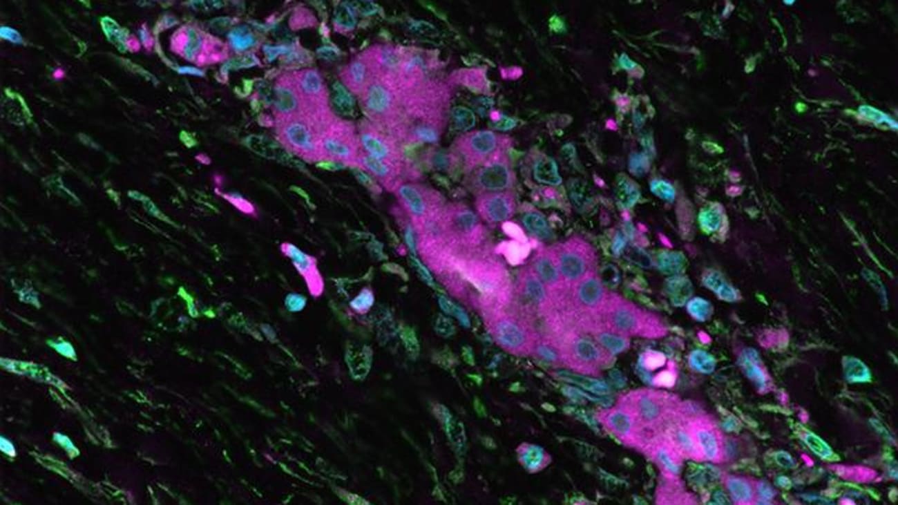 Diseased liver sample from a fibrolamellar carcinoma patient shows tumor cells (pink) in the center surrounded by the fibrotic tissue (streaked with green) characteristic of FLC