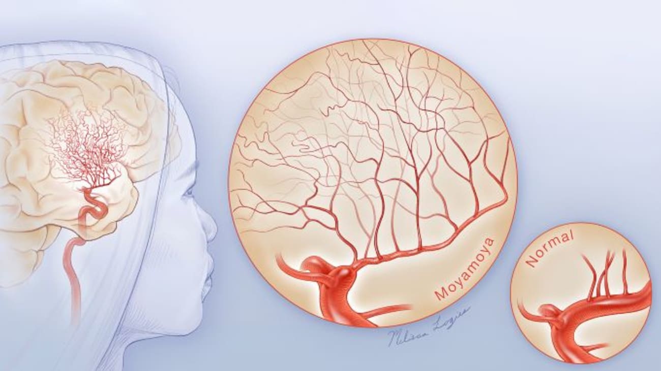 In Moyamoya disease, the body tries to compensate for narrowed or blocked blood vessels by growing tiny, fragile new vessels that can burst or leak, causing bleeding in the brain. (Illustration by Melissa Logies.)