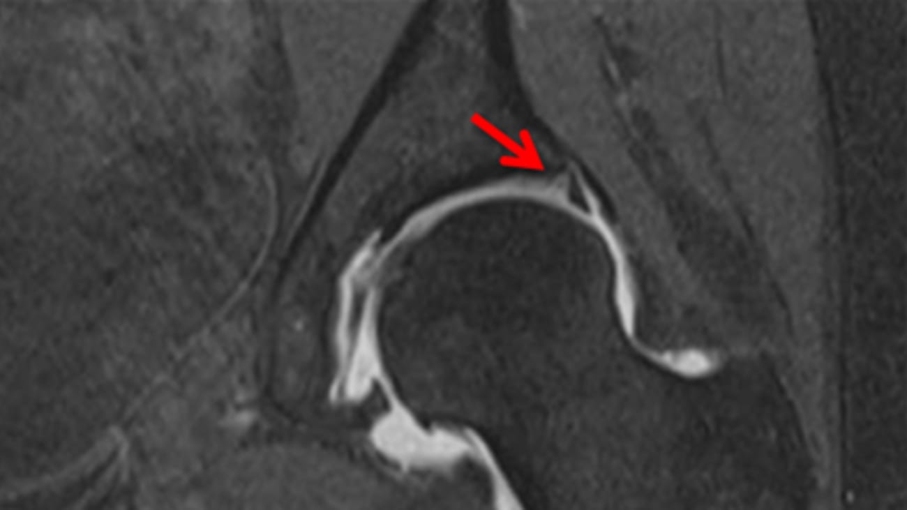 Coronal MR image shows an anterosuperior labral tear.