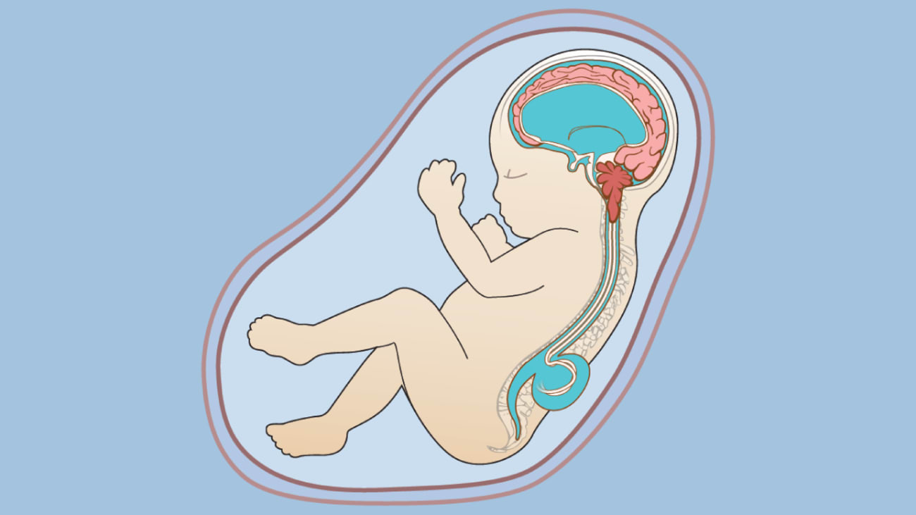 spina bifida.