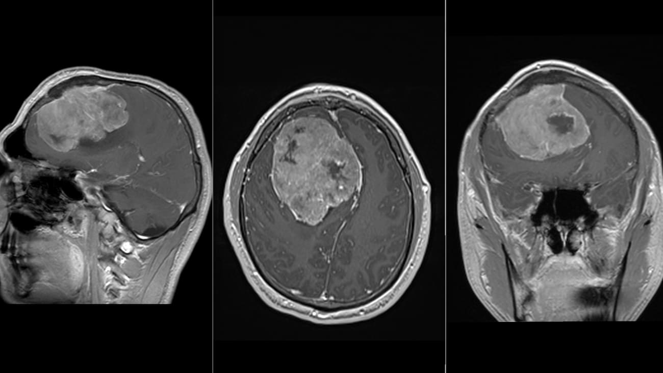 Image of a Meningioma before the procedure