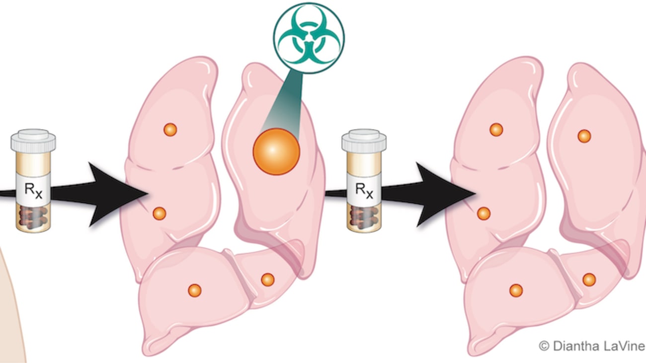 Stereotactic ablative radiation (SAbR) control of isolated progressive metastasis in kidney cancer clinical trial.