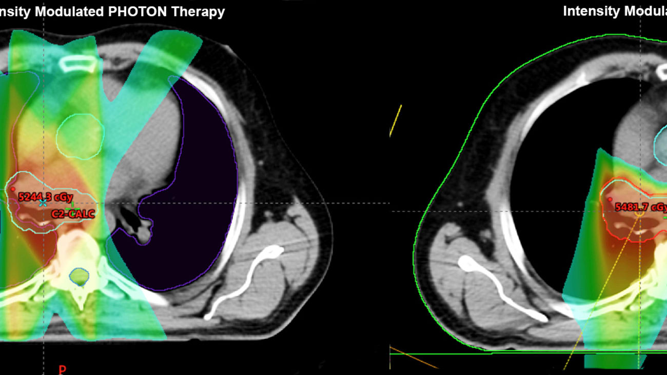 Figure 1: The green colorwash demonstrates the 20 Gy isodose line for a five non-opposed co-planar field IMRT plan (left) compared to a two field IMPT plan (right) that were both prescribed to 50.4 Gy. It is obvious that the mean heart dose is substantially less, but in this case the maximum dose to the aortic valve prior to a planned replacement is less than four Gy.