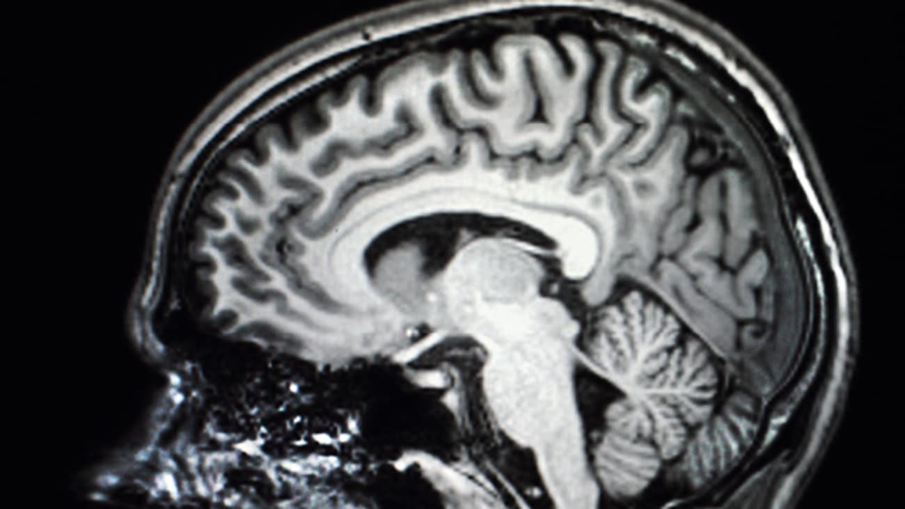 Because standard anatomical imaging of the brain is normal after concussion, advanced imaging techniques are needed to understand how injury changes brain function.