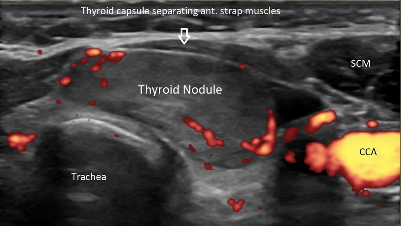 An ultrasound picture of the thyroid nodule, seen as an oval grey mass, sitting on top of the trachea (windpipe). It is surrounded by the anterior strap muscles, sternocleidomastoid muscle and common carotid artery.