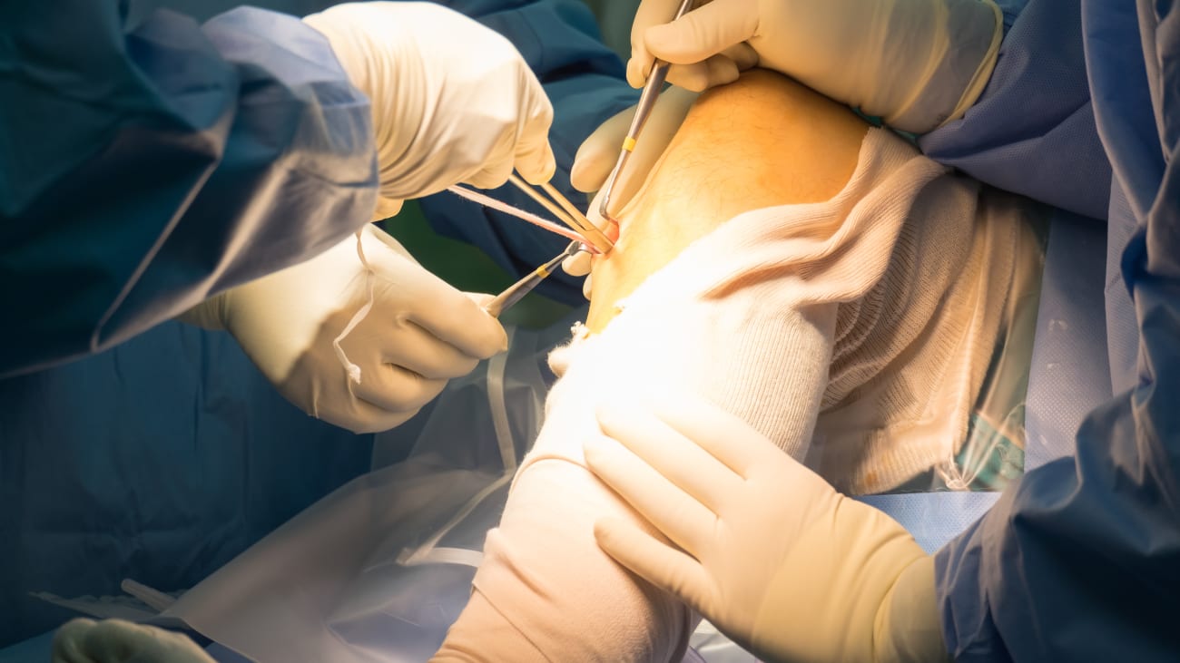 Minimally Invasive Surgery for an ACL Tear: What to Expect: New York Spine  and Sports Surgery: Orthopedic Spine Surgeons