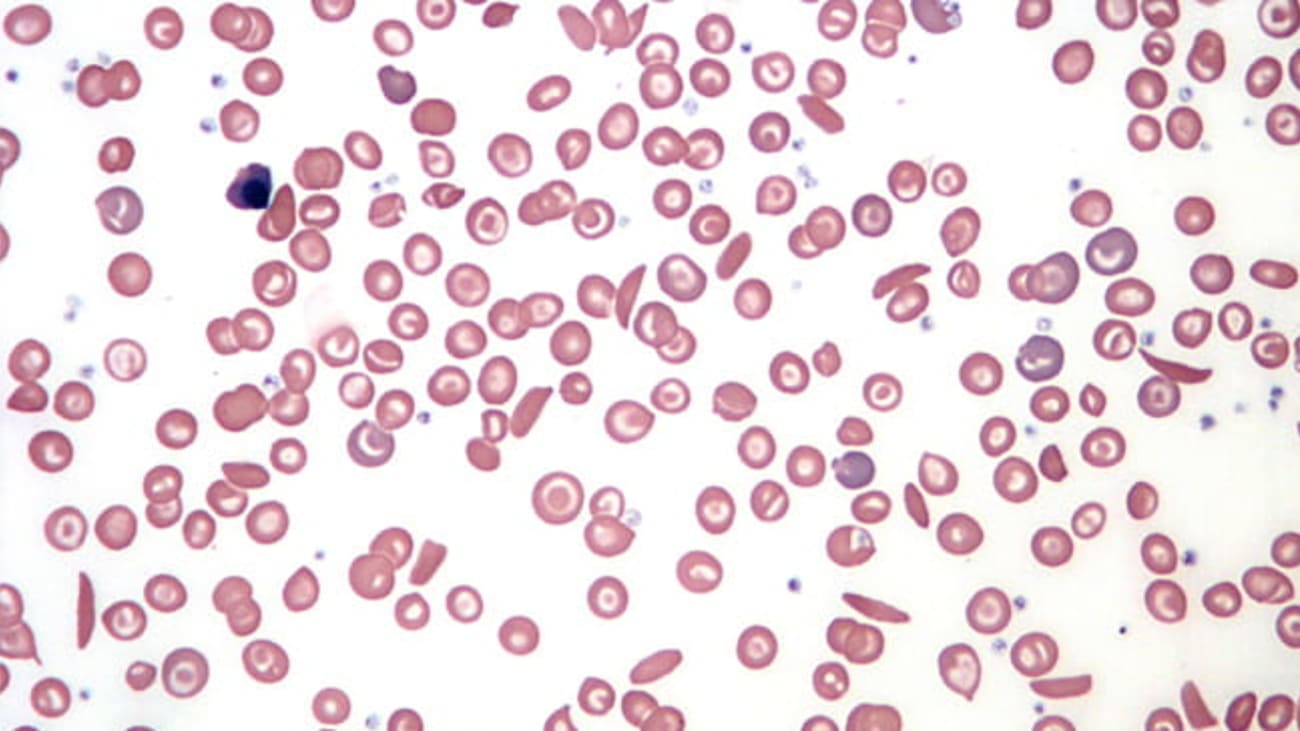 Sickle Cell Disease and ICU