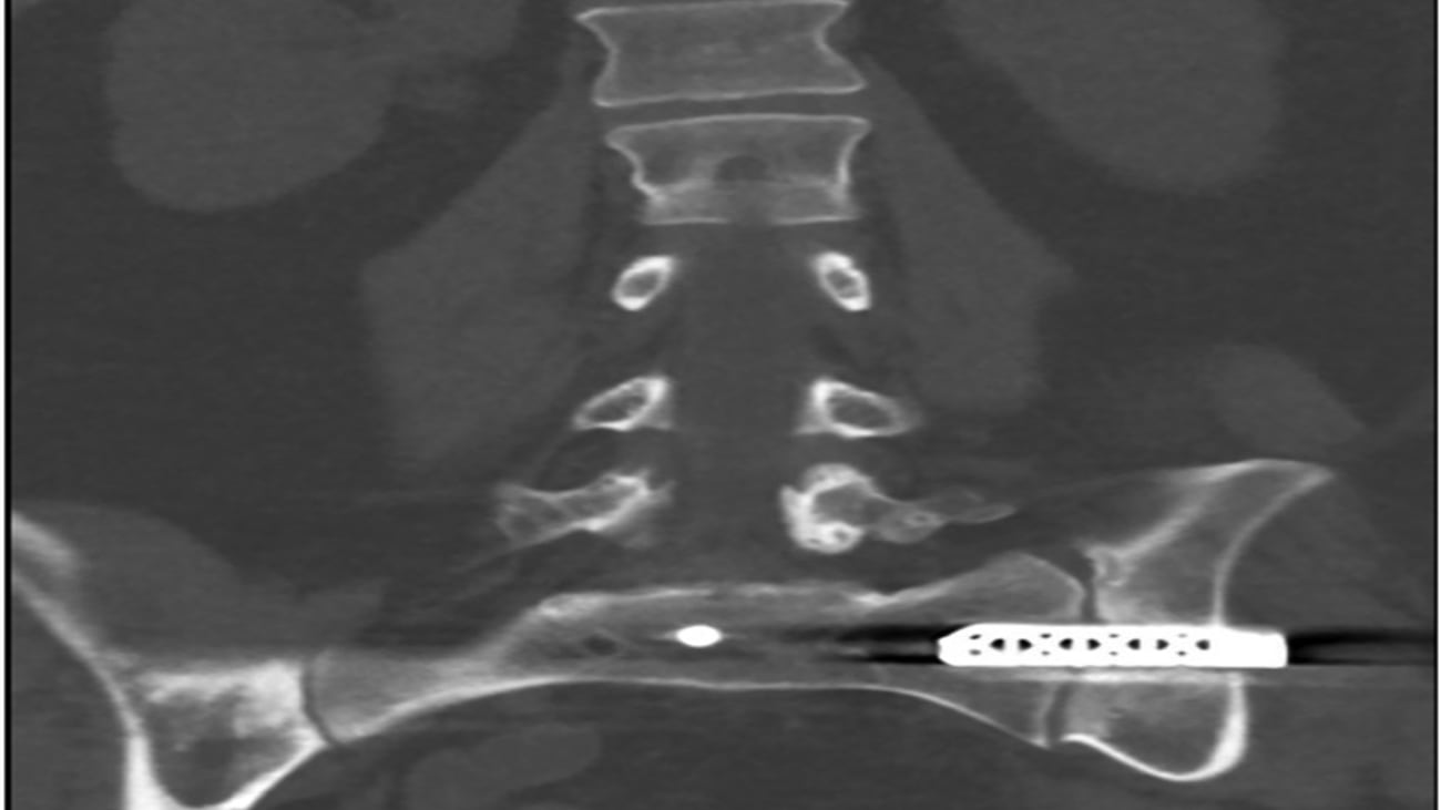 Sacroiliac Fusion Implant