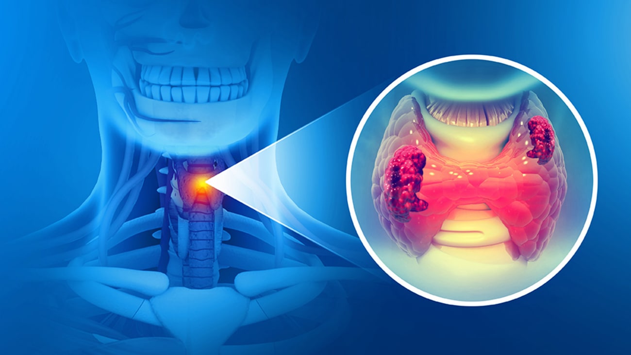 thyroid cancer