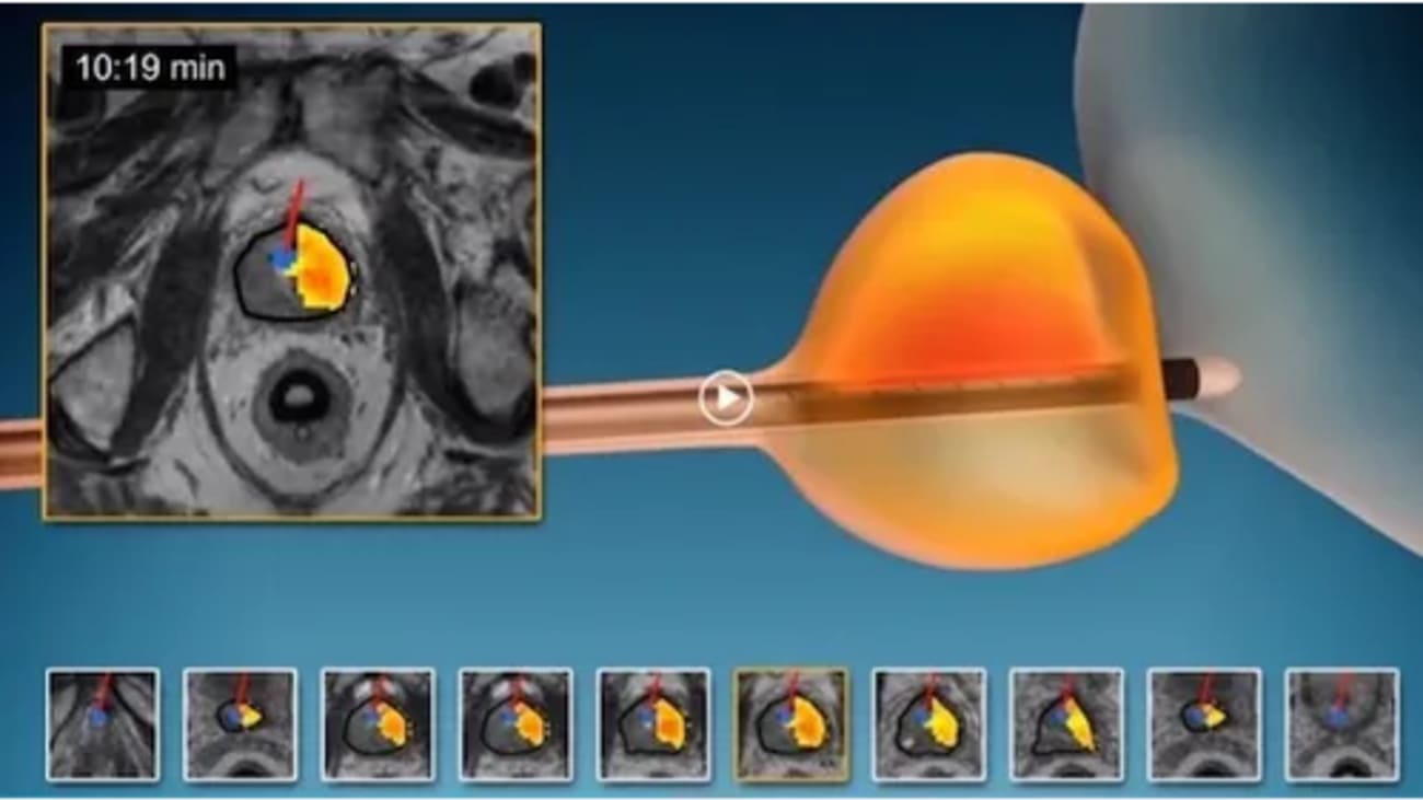 TULSA, or transurethral ultrasound ablation, uses heat to target and destroy cancerous prostate tissue. (Photo courtesy of Profound Medical Corp.)