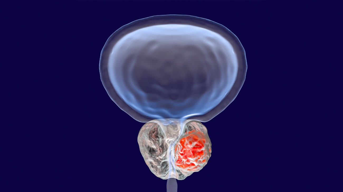 digital image of bladder