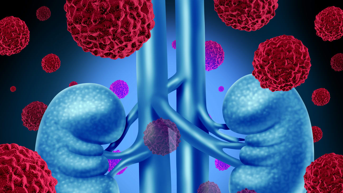 Immunotherapy Drug Delays Recurrence in Kidney Cancer