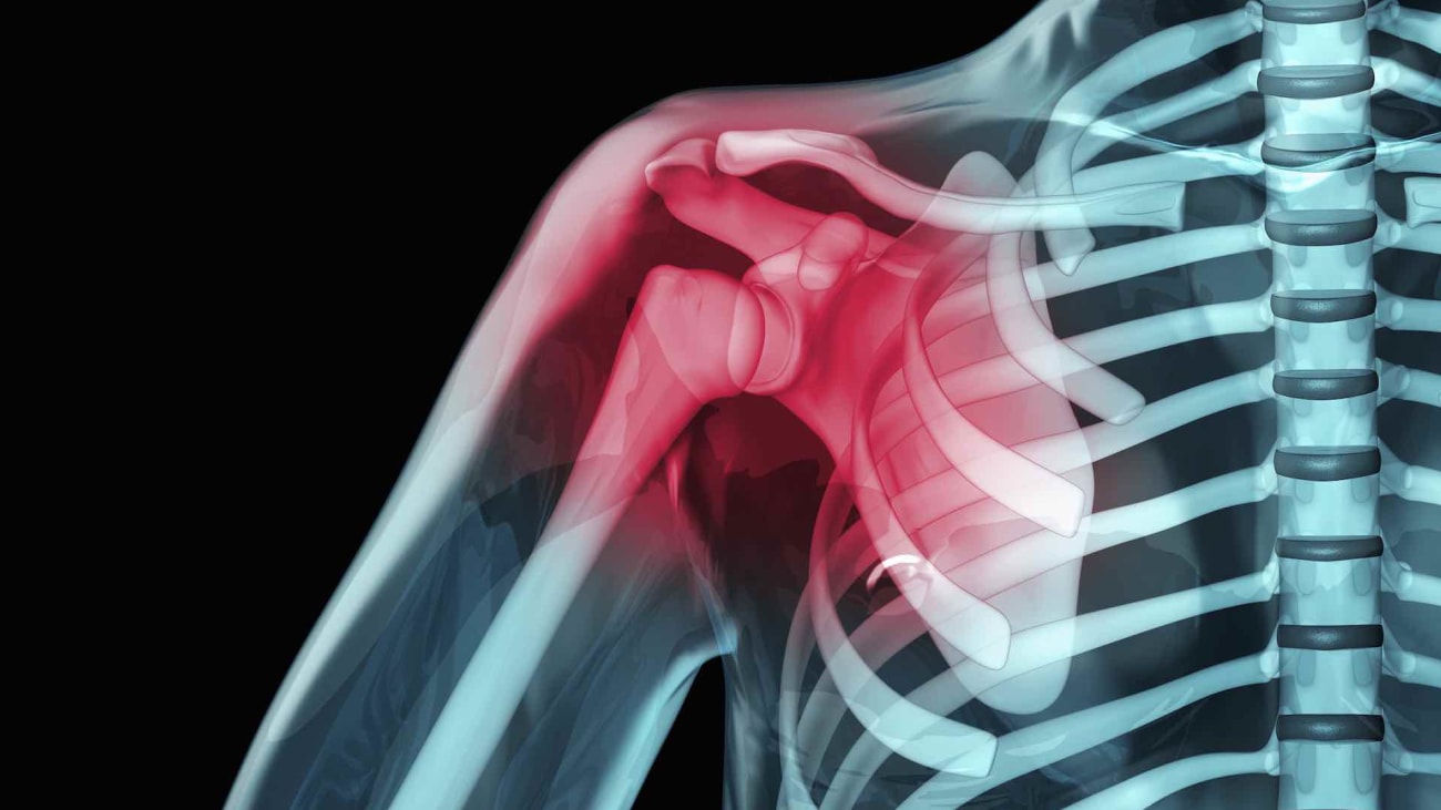 CT Navigation Helps Surgeons To Optimize Total Shoulder ...