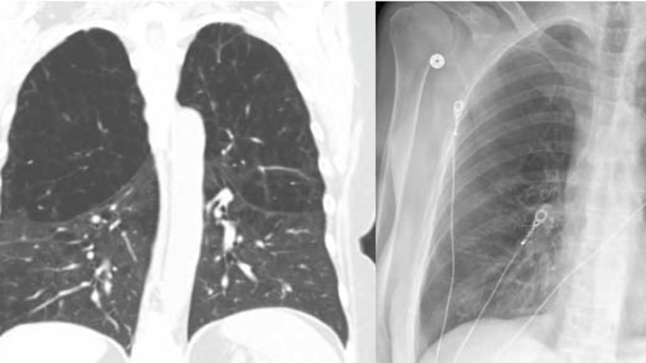 ‘For me, it was a miracle’ Novel treatment improves quality of life