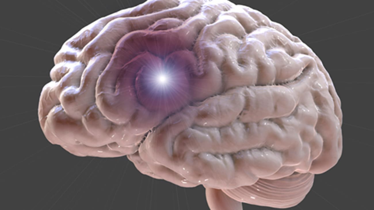 Study Low Complication Rate for Brain Stents CedarsSinai Pulse