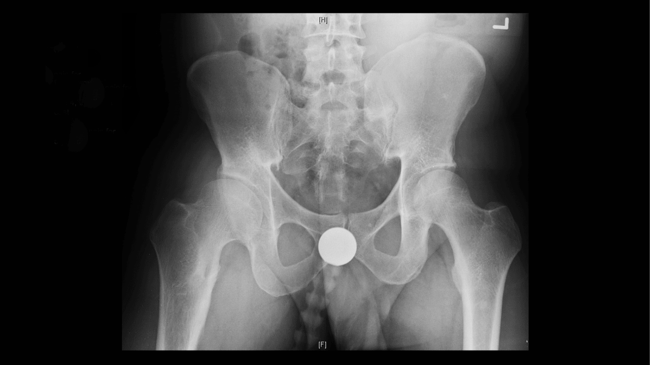 Periacetabular Osteotomy for Complex Structural Hip Deformity Penn
