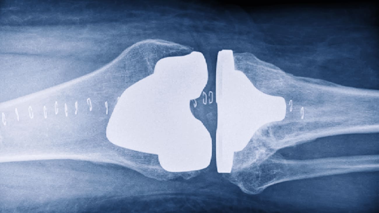AwardWinning Research Questions the Rationale of NickelFree Total