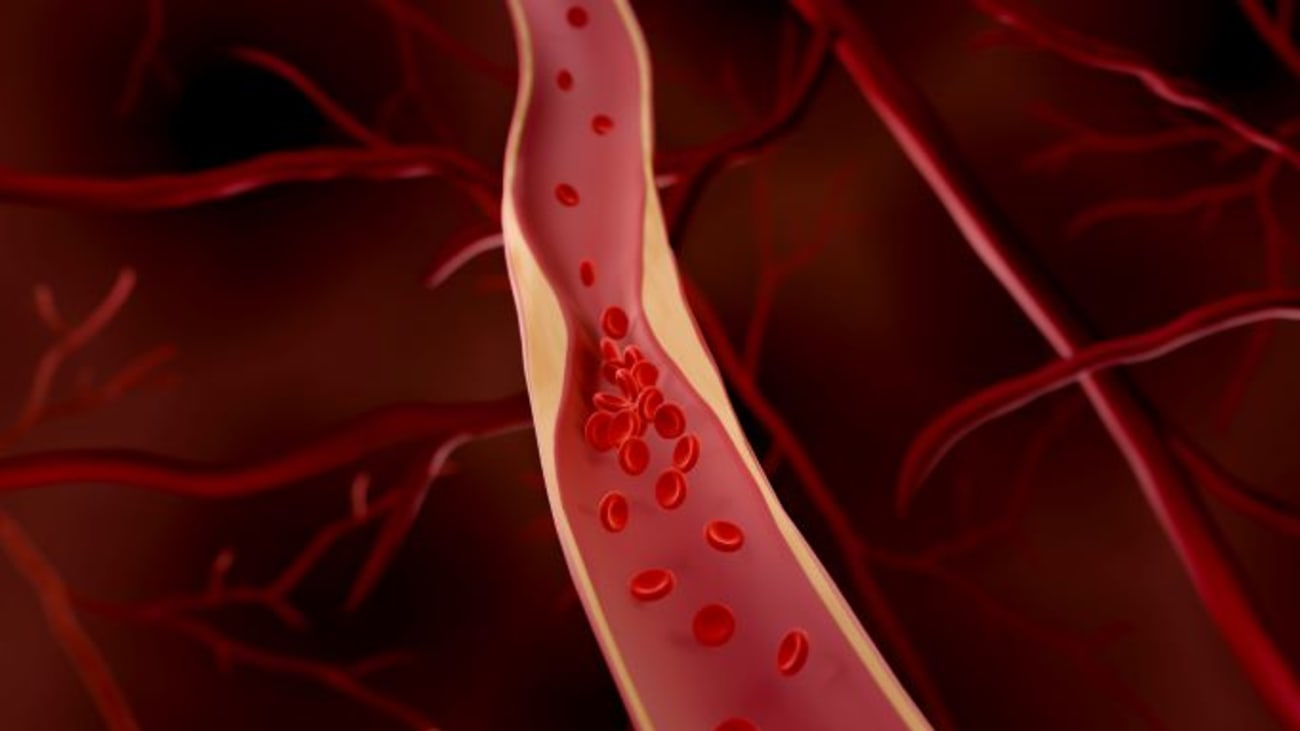 Longterm Marijuana Smoking Can Impair Blood Vessel Function BroadcastMed