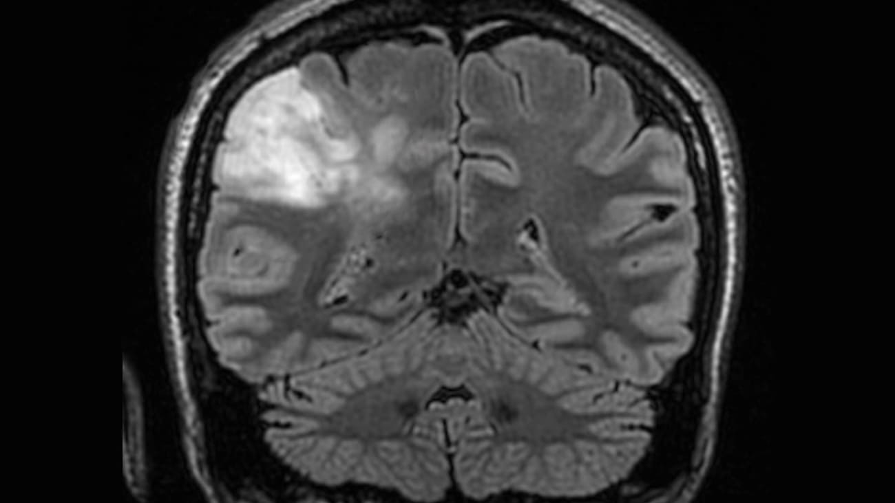 Aggressive Surgery Increases Survival with LowGrade Brain Tumors