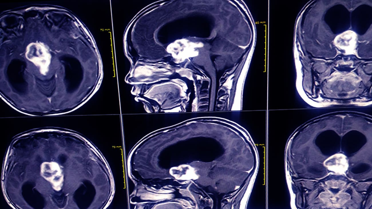 How a Routine Eye Exam Found a Brain Tumor and Saved a Patient’s Life