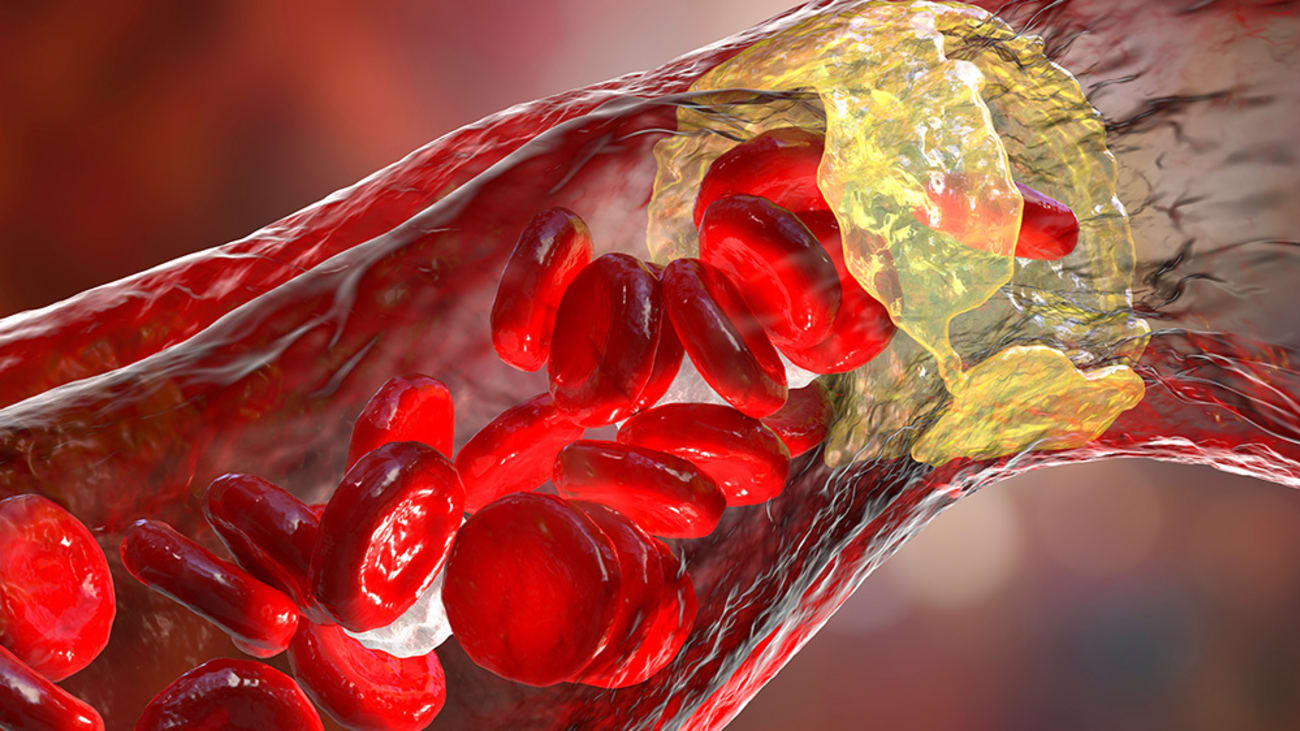 Heart and Brain Health After Menopause Clinical Trial Examines