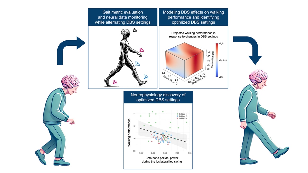 Tailored Deep Brain Stimulation Improves Walking in Parkinson's