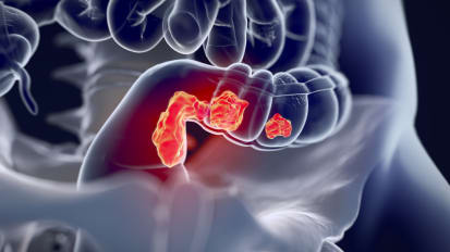 Evolution in the Management of Rectal Cancer: Radical Surgery, Local Excision, Observation